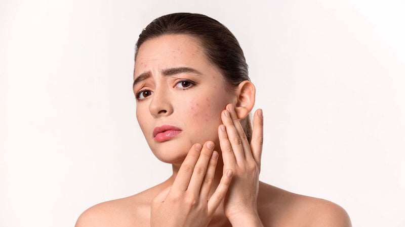 Why Hormonal Acne Won’t Go Away: Common Mistakes
