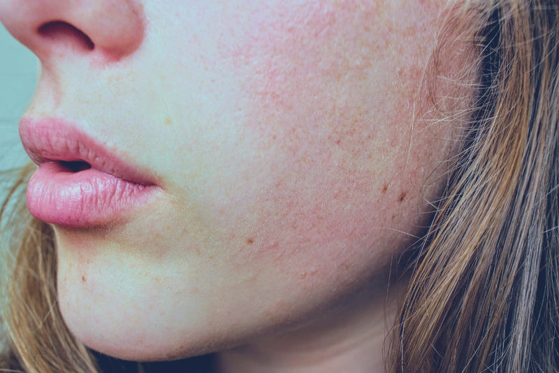 How Hormones Affect Your Skin Health
