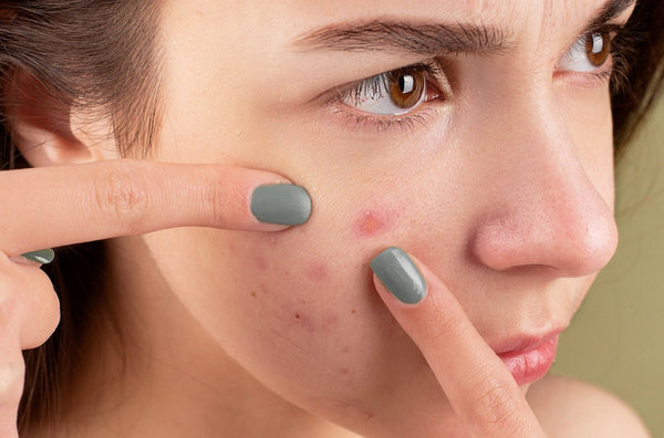 Hormonal Acne: How to Get Rid of Adult Acne Naturally